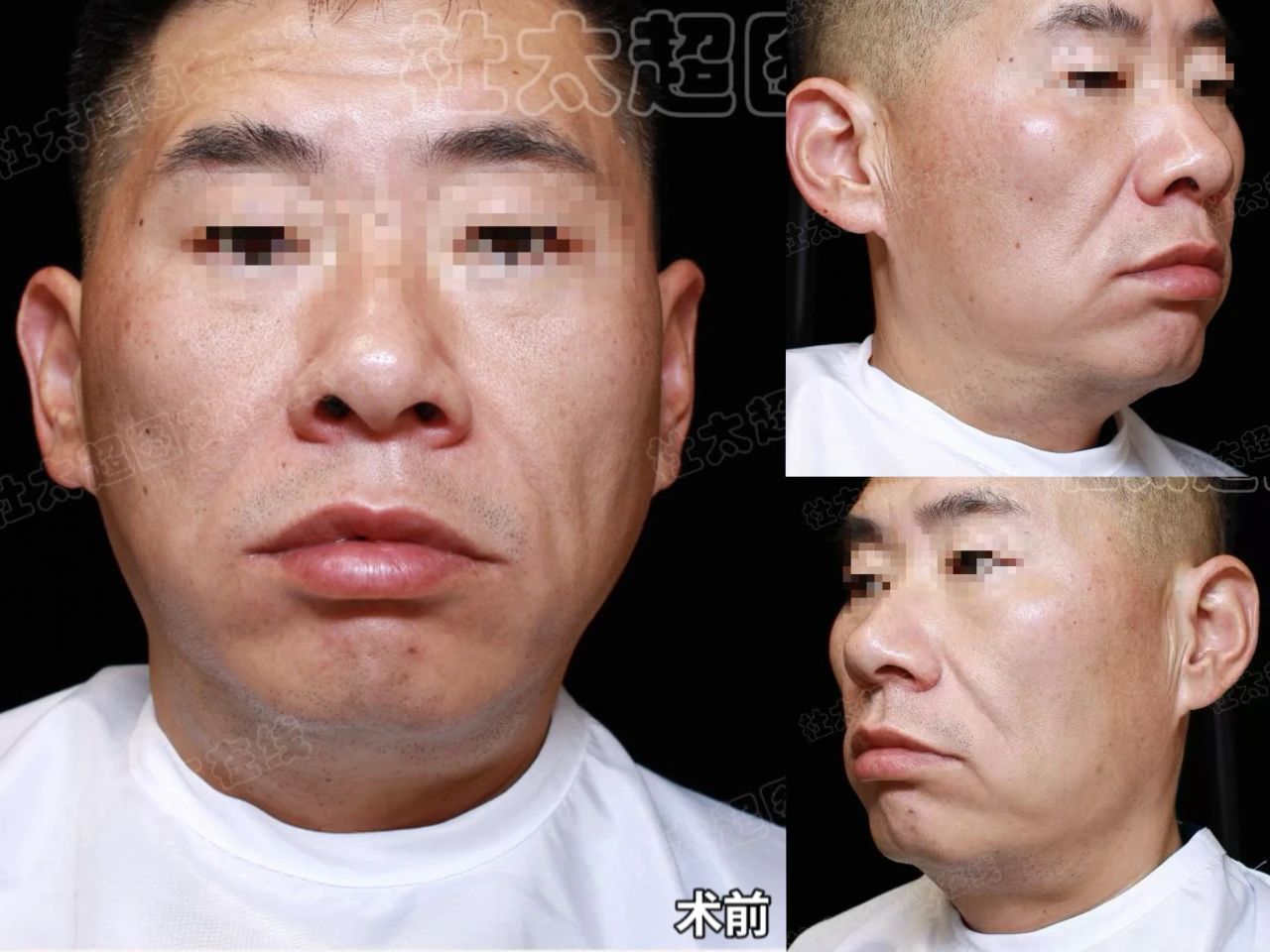 天没塌，脸耷了！北京几万的拉皮手术，我终究还是做了！
